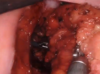 A combined robotic approach of a synchronous upper rectal and prostate cancer