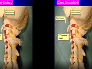 A far-lateral approach for removal of a C1--2 extradural neurofibroma (3D)