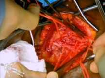 A Lateral Approach to the Popliteal Artery A Lateral Approach to the Popliteal Artery