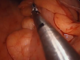 A New Approach for Rectal Prolapse: Perineal Proctectomy with TAMIS Rectopexy and Mesh Fixation A New Approach for Rectal Prolapse: Perineal Proctectomy with TAMIS Rectopexy and Mesh Fixation