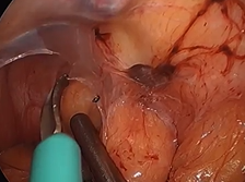 A New Approach for Rectal Prolapse: Perineal Proctectomy with TAMIS Rectopexy and Mesh Fixation A New Approach for Rectal Prolapse: Perineal Proctectomy with TAMIS Rectopexy and Mesh Fixation