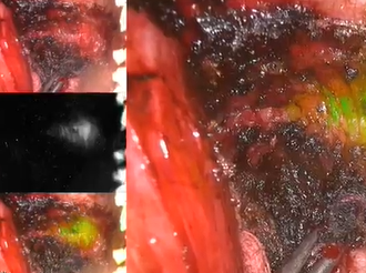 A Novel Use of Near Infra-red Light in Assisting with TaTME Planes