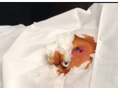 abdominal abscess with cellulitis