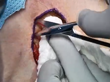 Abdominal Dermal Fat Graft Harvest