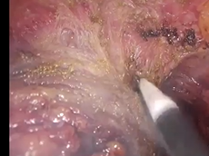 Abdominal-perineal Excision for Low Rectal Cancer Performed by Double Laparoscopy Approach Abdominal-perineal Excision for Low Rectal Cancer Performed by Double Laparoscopy Approach