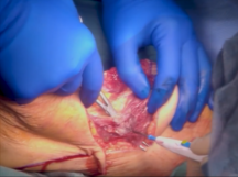 Above Knee Amputation (AKA) Above Knee Amputation (AKA)