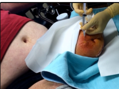 Abscess in left stump drainage