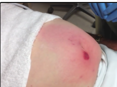 abscess with complicated cellulitis