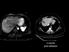 AC21 - Bruno Odisio: Ablation & Chemoembolization (TACE) AC21 - Bruno Odisio: Ablation & Chemoembolization (TACE)