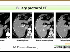 AC21 - Christine Kang: Imaging of Perihilar Cholangiocarcinoma AC21 - Christine Kang: Imaging of Perihilar Cholangiocarcinoma