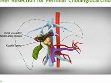AC21 - Gonzalo Sapisochin: Management of Perihilar Cholangiocarcinoma - Surgical + Transplant AC21 - Gonzalo Sapisochin: Management of Perihilar Cholangiocarcinoma - Surgical + Transplant