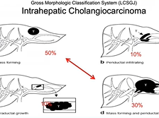AC21 - Tim Pawlik: Surgical Management of Intrahepatic Cholangiocarcinoma AC21 - Tim Pawlik: Surgical Management of Intrahepatic Cholangiocarcinoma