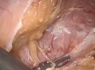 ACPGBI 2018: Robotic Ventral Mesh Rectopexy