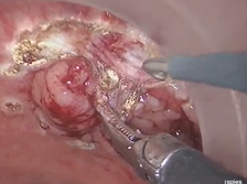 ACPGBI 2018 Video: Minimally Invasive Transanal Resection of Low Rectal Polyp (TAMIS) ACPGBI 2018 Video: Minimally Invasive Transanal Resection of Low Rectal Polyp (TAMIS)