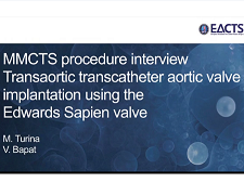 Cardiopathie acquise - MMCTS: implantation de valve aortique par transcatheter transaortique, en utilisant le Sapien d'Edward vivant Cardiopathie acquise - MMCTS: implantation de valve aortique par transcatheter transaortique, en utilisant le Sapien d'Edward vivant