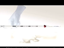 Acute or chronic urine retention in males