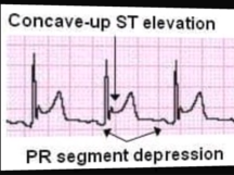 Acute pericarditis (ECG)