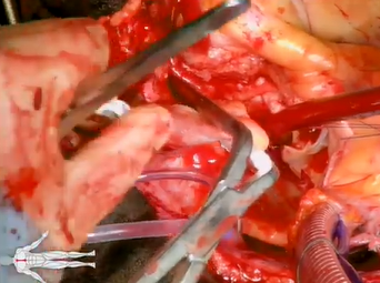 Acute Type-A Aortic Dissection Repair with Bentall Procedure (Ramchandani MD, Spooner MD, Zubair MD) Acute Type-A Aortic Dissection Repair with Bentall Procedure (Ramchandani MD, Spooner MD, Zubair MD)