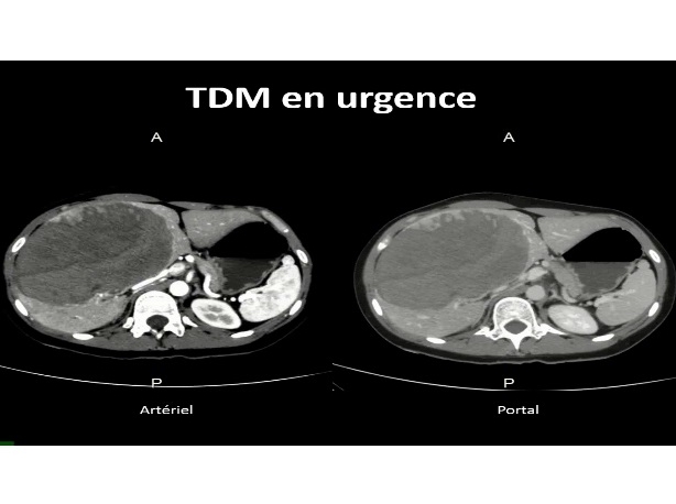 Adénome hémorragique objectif place de l'embolisation et de la chirurgie