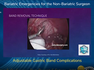 Adjustable Gastric Band Complications