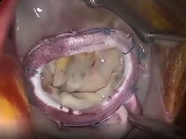 Adjustable mitral annuloplasty