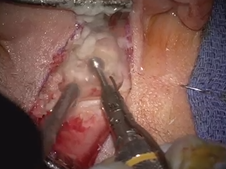 Adult cochlear implantation