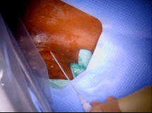 Advanced Methods of IVC Filter Retrieval Advanced Methods of IVC Filter Retrieval