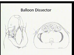Advanced Ventral Hernia Repair Session: Components Separation - Laparoscopic And Open Advanced Ventral Hernia Repair Session: Components Separation - Laparoscopic And Open