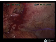 Advanced Ventral Hernia Repair Session: Laparoscopic Repair Of Parastomal Hernias Advanced Ventral Hernia Repair Session: Laparoscopic Repair Of Parastomal Hernias