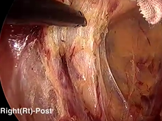 Advantages of the Transanal Approach for Intersphincteric Resection