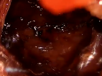 Advantages of Transperineal Approach for Rectal Cancer following Radiotherapy to Prostate Cancer Advantages of Transperineal Approach for Rectal Cancer following Radiotherapy to Prostate Cancer