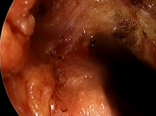 Advantages of Transperineal Approach for Rectal Cancer following Radiotherapy to Prostate Cancer Advantages of Transperineal Approach for Rectal Cancer following Radiotherapy to Prostate Cancer