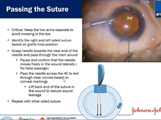 AIOS International Webinar on Endothelial Keratoplasty