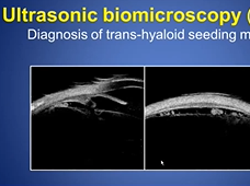 AIOS International Webinar on Ocular Oncology - What New am I Doing in 2020 with a Key Note by Dr Ca AIOS International Webinar on Ocular Oncology - What New am I Doing in 2020 with a Key Note by Dr Ca