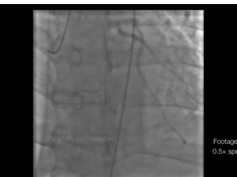 ALCAPA: Anomalous Left Coronary Artery From the Pulmonary Artery