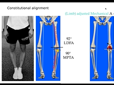 Alignment Techniques for Knee Replacement - SEMANTICS: Rational and Evidence 2020 Alignment Techniques for Knee Replacement - SEMANTICS: Rational and Evidence 2020