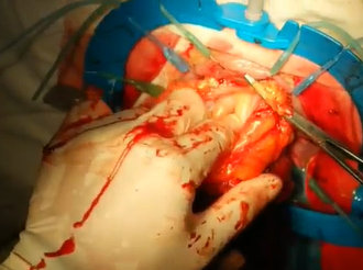 Altemeier Procedure for Full-thickness Rectal Prolapse Complicated by Ischemic Stricture Altemeier Procedure for Full-thickness Rectal Prolapse Complicated by Ischemic Stricture