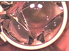 Alternative Method for Delivering the EX-PRESS Shunt Into the Anterior Chamber Alternative Method for Delivering the EX-PRESS Shunt Into the Anterior Chamber