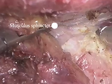 Amelioration of Intersphincteric Resection of Low Rectal Cancer - Preserving Defecation Function! Amelioration of Intersphincteric Resection of Low Rectal Cancer - Preserving Defecation Function!