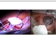 Amniotic Membrane Transplant for Eye Surface Reconstruction Amniotic Membrane Transplant for Eye Surface Reconstruction