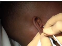 an abscess inside the ear?