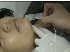 An Example of Laryngeal Electromyography-Guided Hyaluronic Acid Injection in Paralyzed Vocal Fold Wi An Example of Laryngeal Electromyography-Guided Hyaluronic Acid Injection in Paralyzed Vocal Fold Wi
