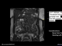 An Unusual Case of Renal Vein Entrapment Syndrome An Unusual Case of Renal Vein Entrapment Syndrome