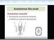 Anastomose iléo-anale: technique et complications Anastomose iléo-anale: technique et complications