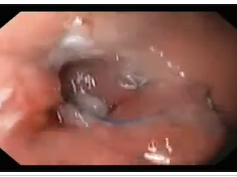 Anastomotic Ulcer and Edema Following Gastric Bypass