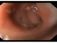 Anastomotic Ulcer Following Gastric Bypass - 2