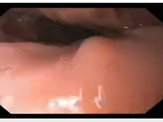 Anastomotic Ulcer Following Gastric Bypass