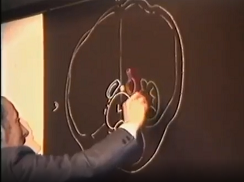 Anatomie chirurgicale des voies biliaires extra-hépatiques