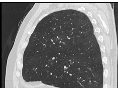 Anatomy - Normal anatomy of right lung on CT Anatomy - Normal anatomy of right lung on CT