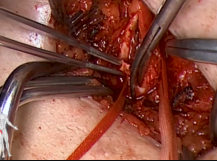 Angioseal CFA Thrombectomy Angioseal CFA Thrombectomy